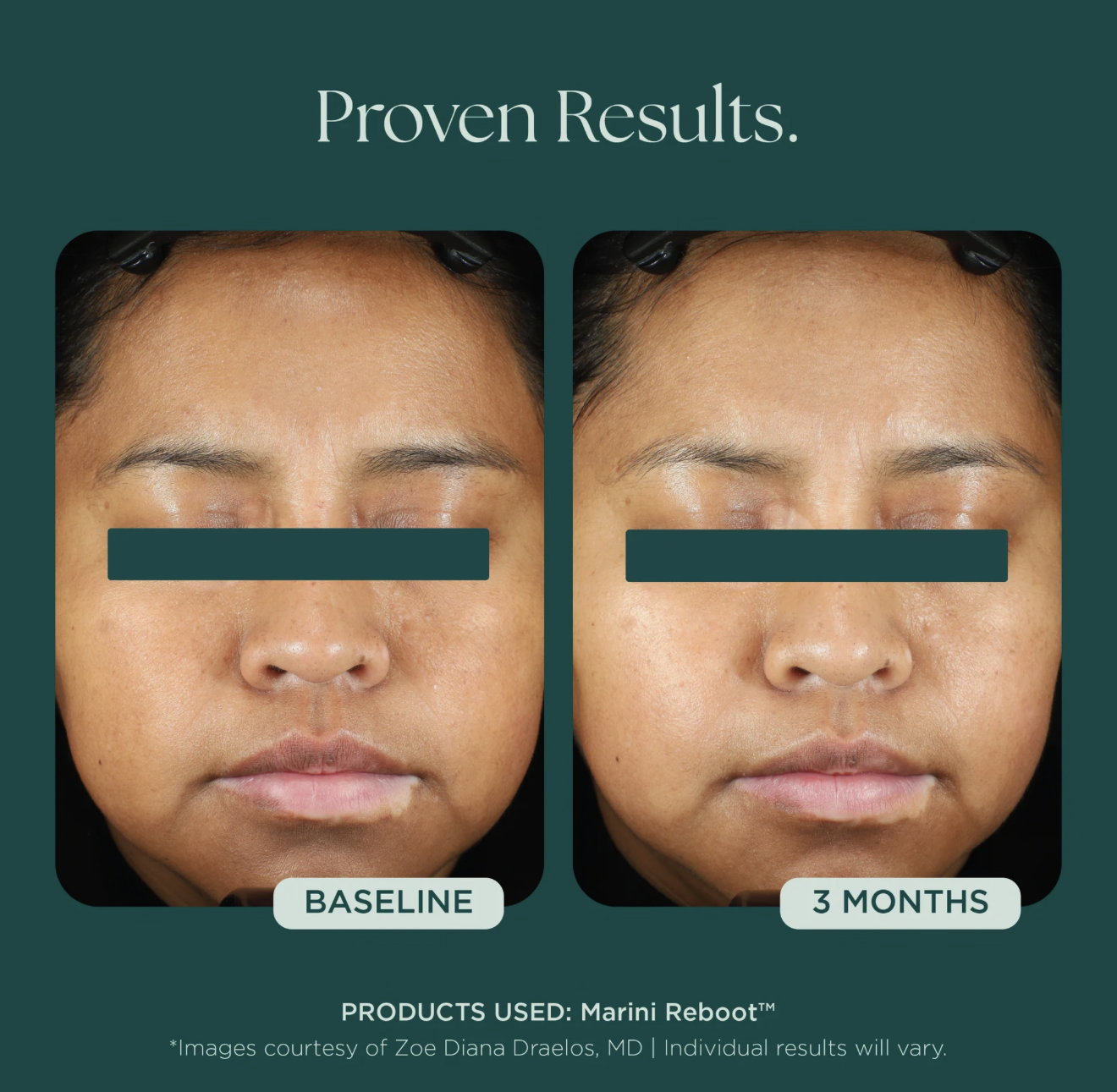 Marini Reboot® PDRN Face Serum