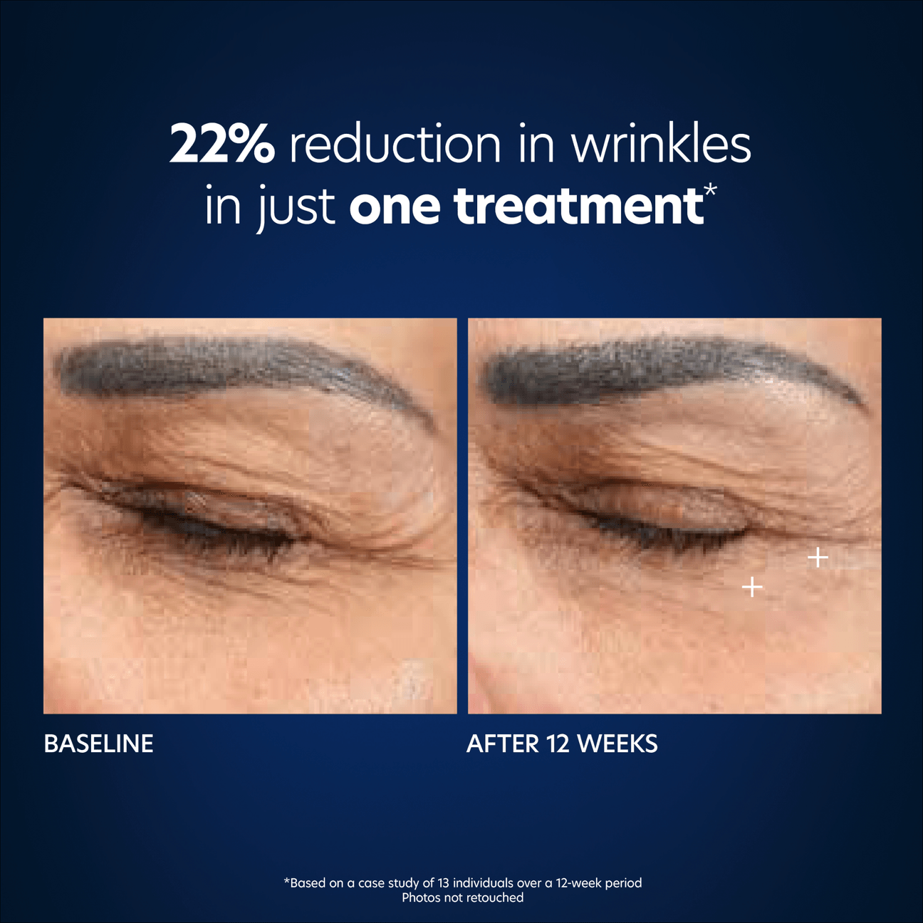 Microneedling Eye Patch