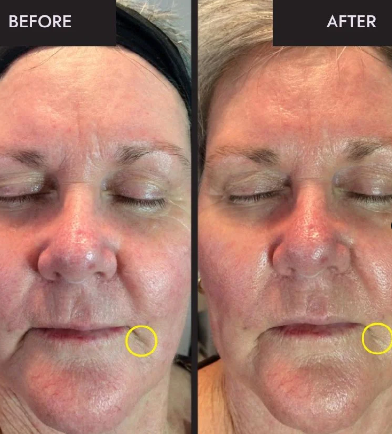MyoLift™ QT Plus Facial Toning Device