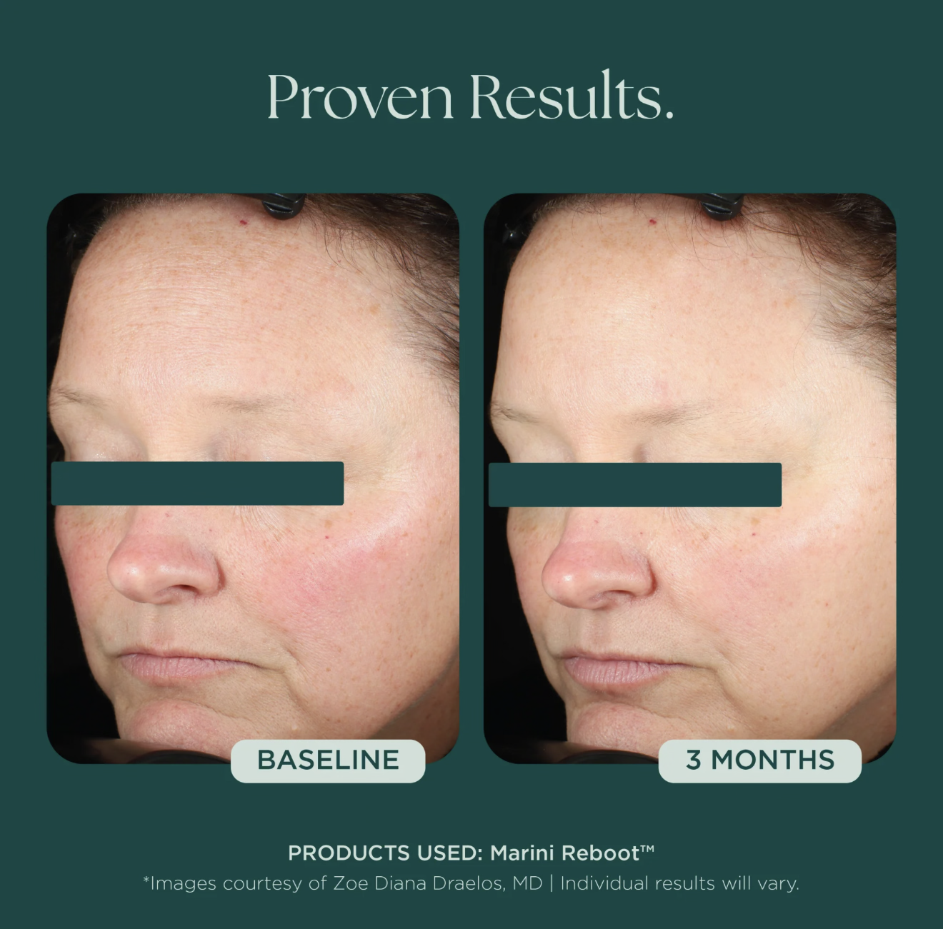 Marini Reboot® PDRN Face Serum