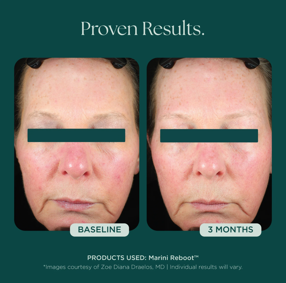 Marini Reboot® PDRN Face Serum