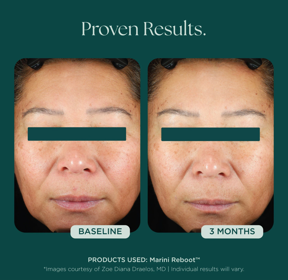 Marini Reboot® PDRN Face Serum