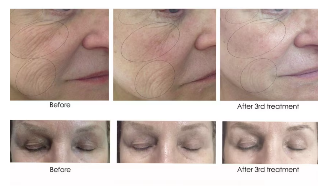 CO2Lift Pro Carboxy Gel Treatment - 3 Treatments